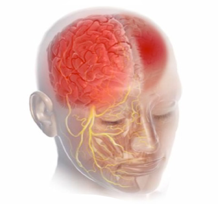 Una Cefalea Giornaliera