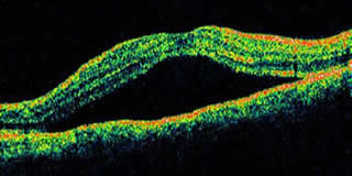 Retinopatia sierosa centrale